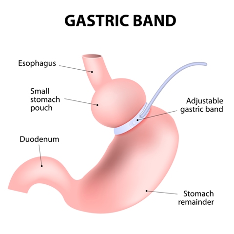 Gastric Band
              Hypnotherapy